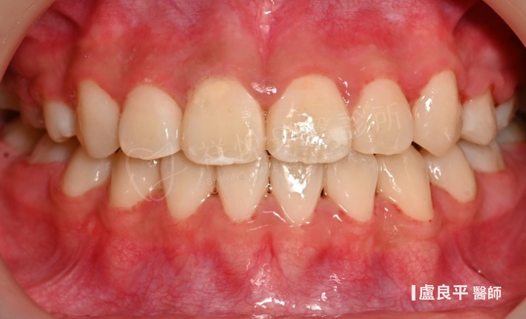 傳統矯正治療後