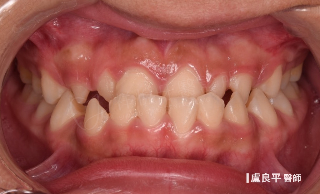 傳統矯正治療前