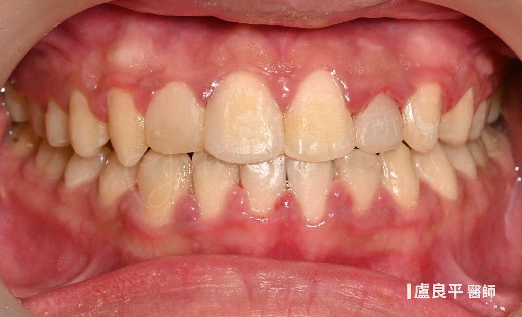 傳統矯正治療後