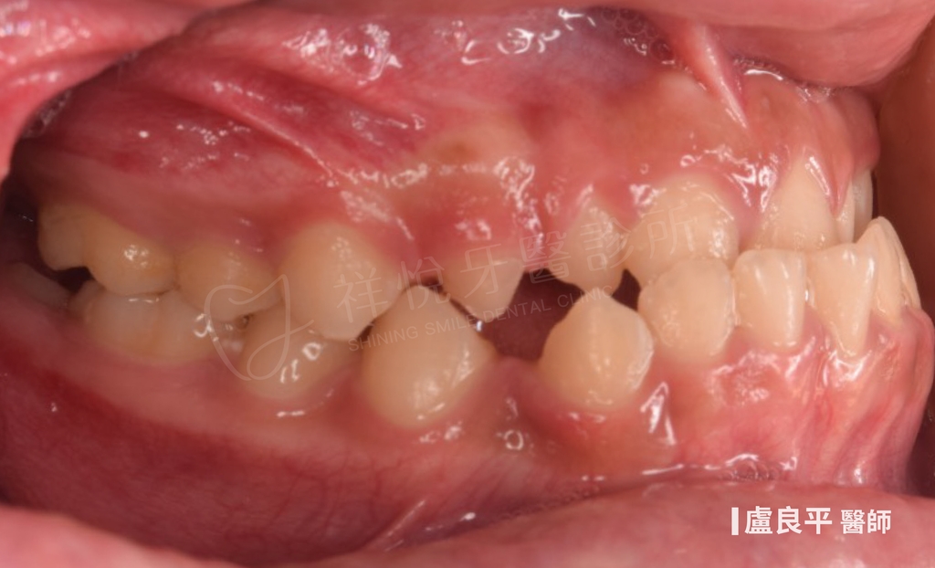 傳統矯正治療前