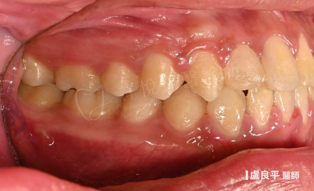 傳統矯正治療後