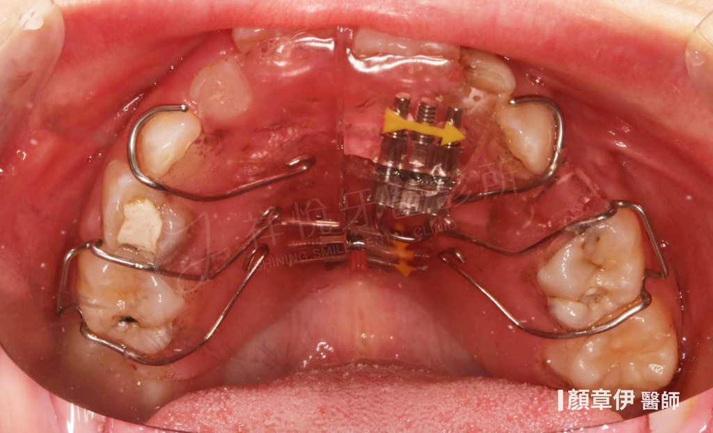 傳統矯正治療前