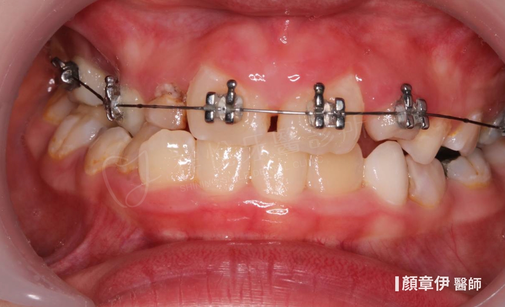 傳統矯正治療後