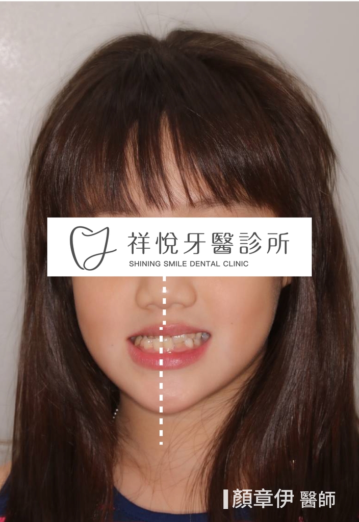 傳統矯正治療前