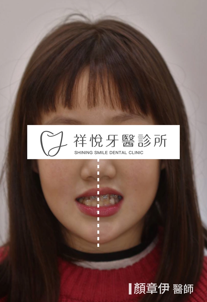 傳統矯正治療後