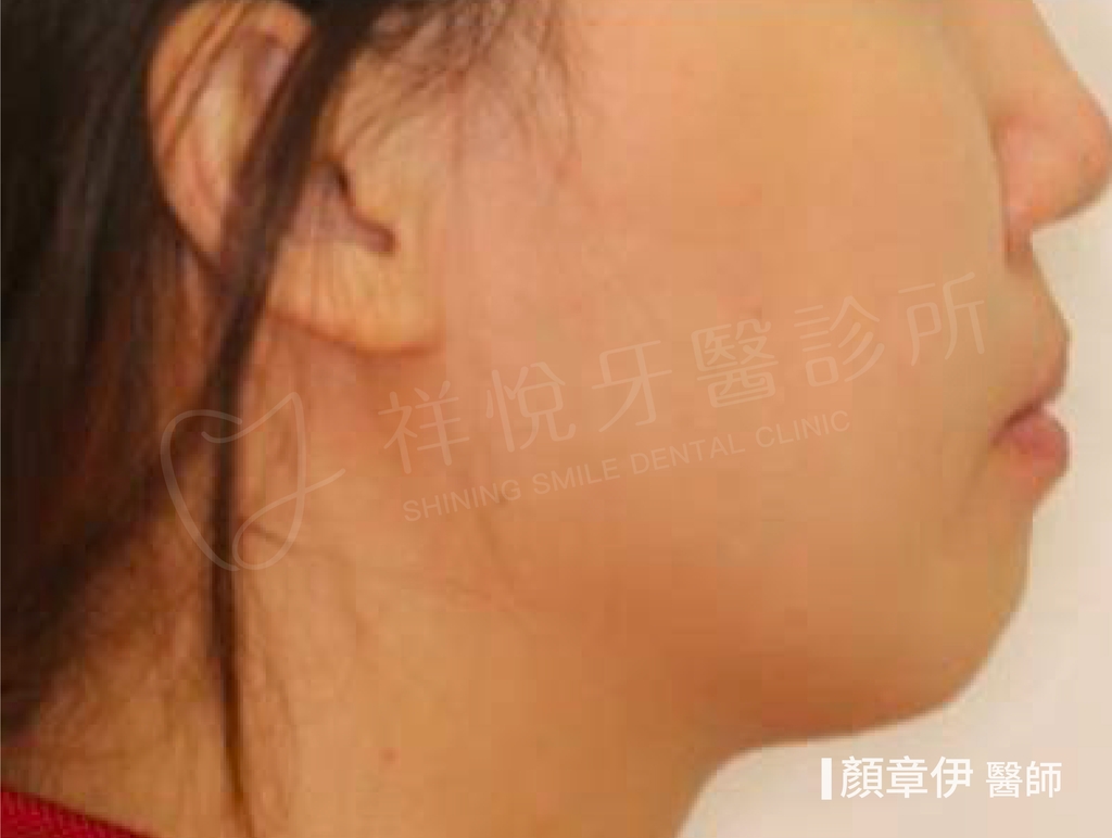 傳統矯正治療前