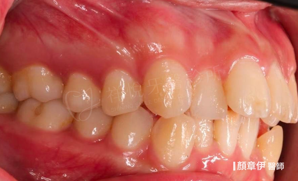 傳統矯正治療前