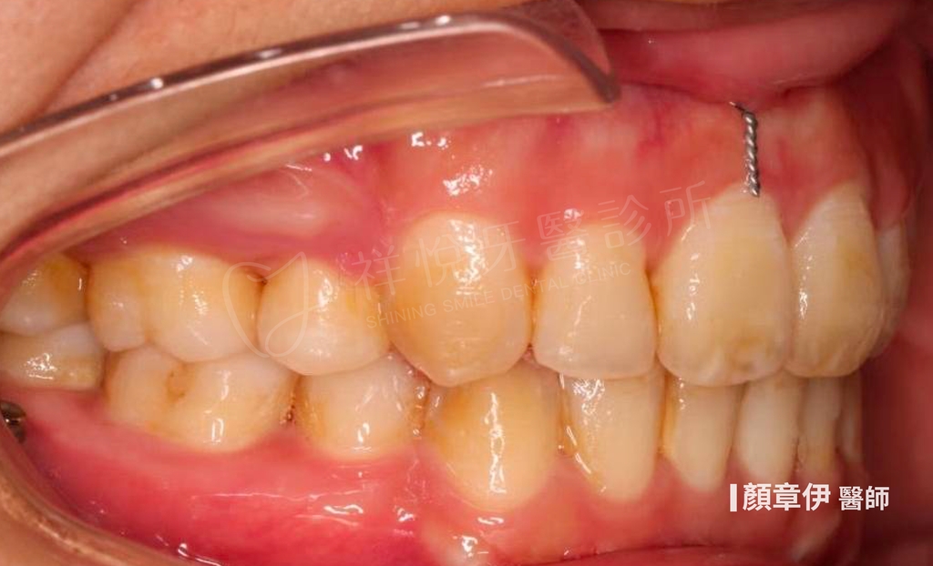 傳統矯正治療後