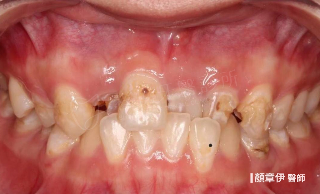 傳統矯正治療前