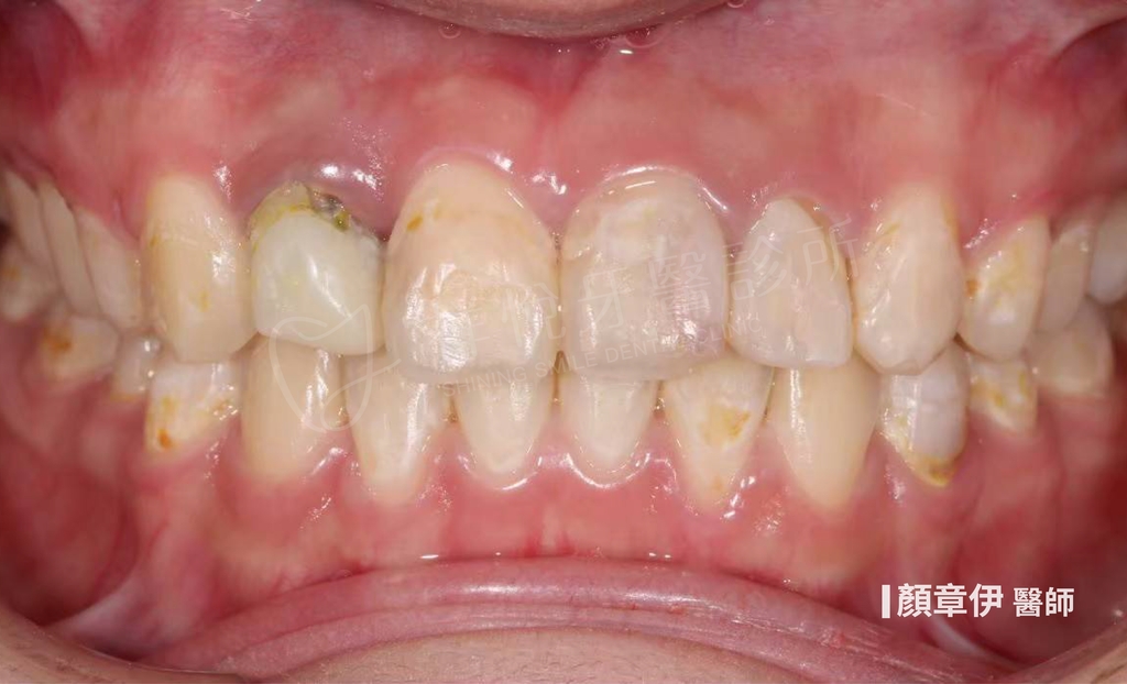 傳統矯正治療後