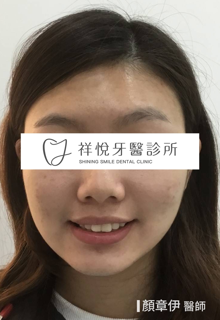 傳統矯正治療前