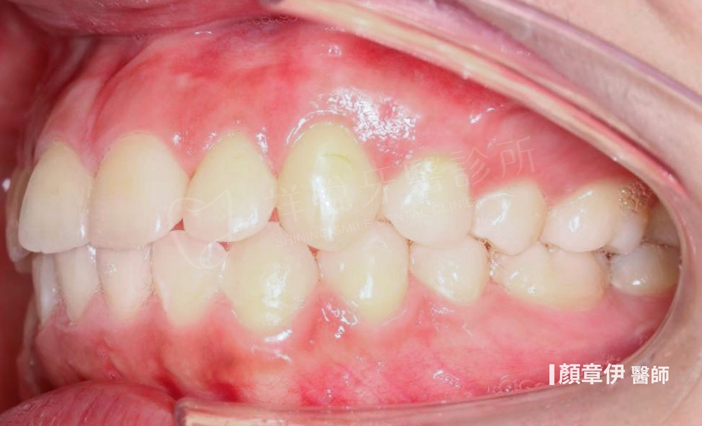 傳統矯正治療後