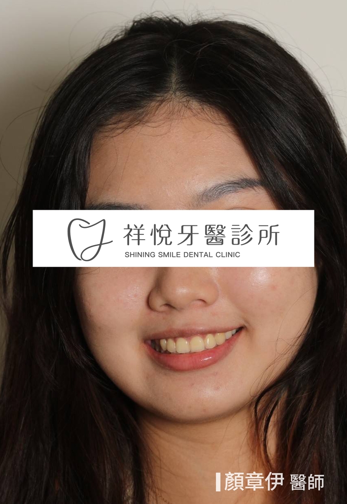 傳統矯正治療前