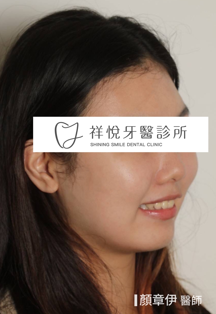 傳統矯正治療前