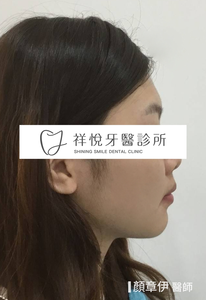 傳統矯正治療後