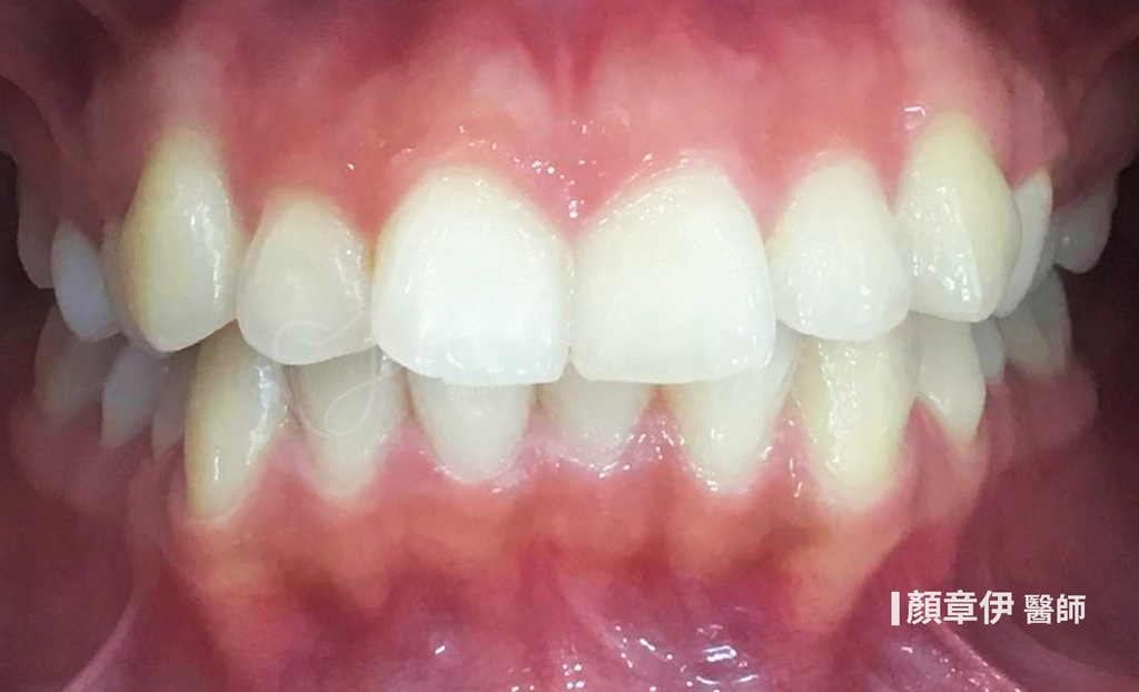 傳統矯正治療後