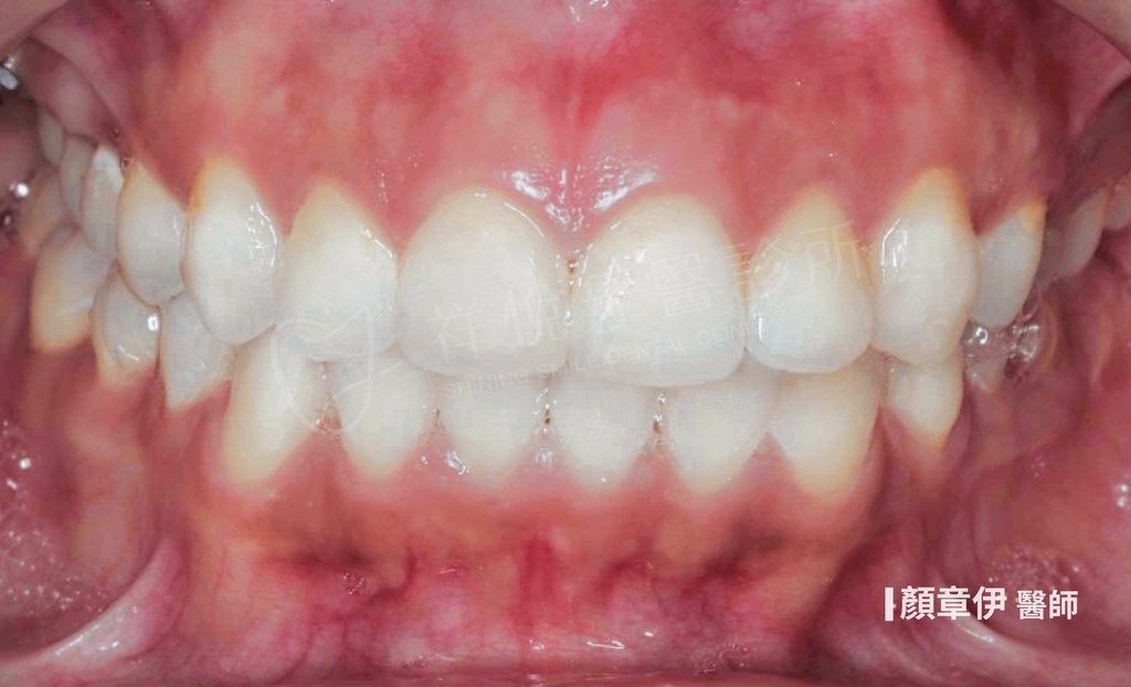 傳統矯正治療前