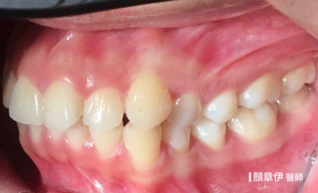 傳統矯正治療後