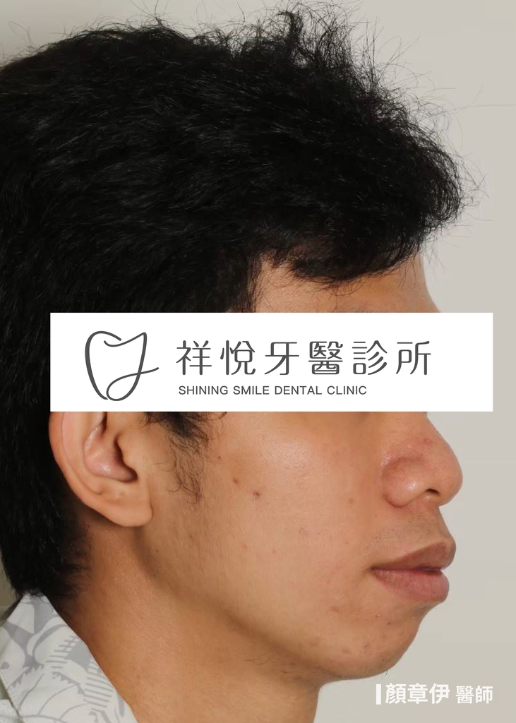 傳統矯正治療前