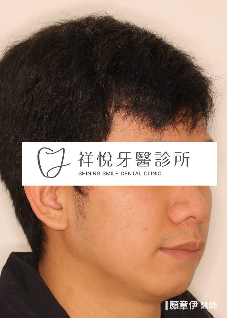 傳統矯正治療後