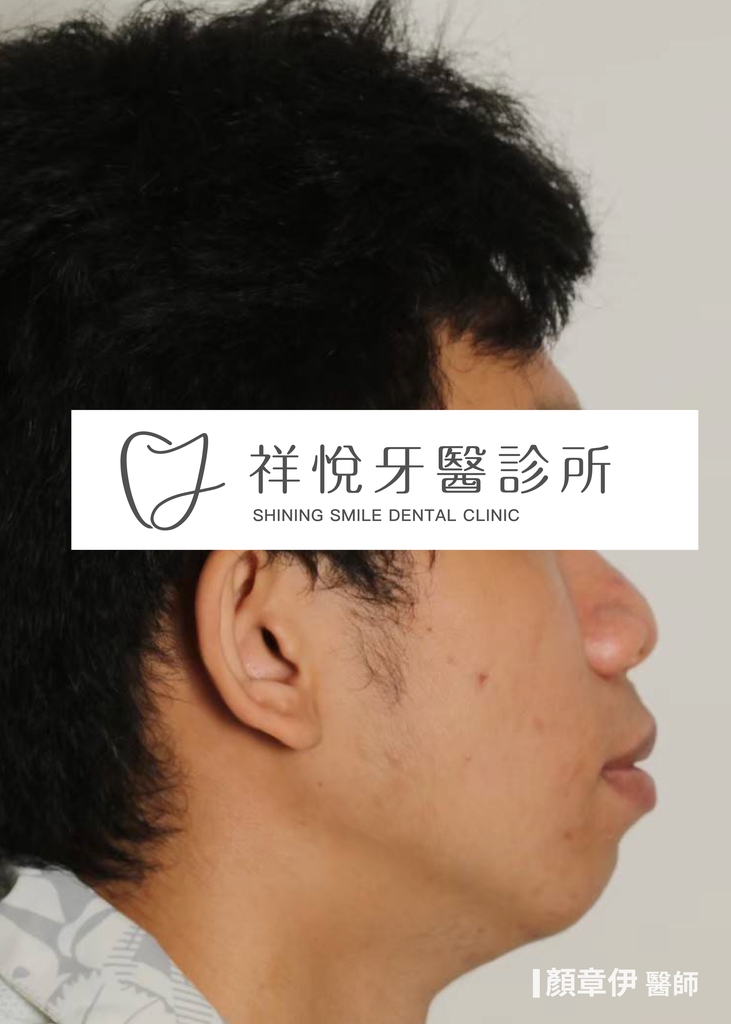 傳統矯正治療前