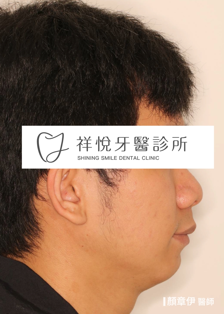 傳統矯正治療後