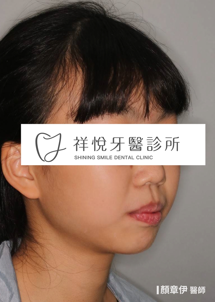 傳統矯正治療前