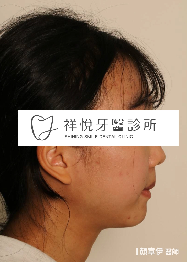 傳統矯正治療後