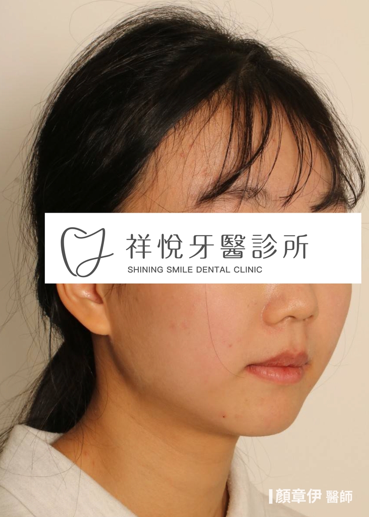 傳統矯正治療後