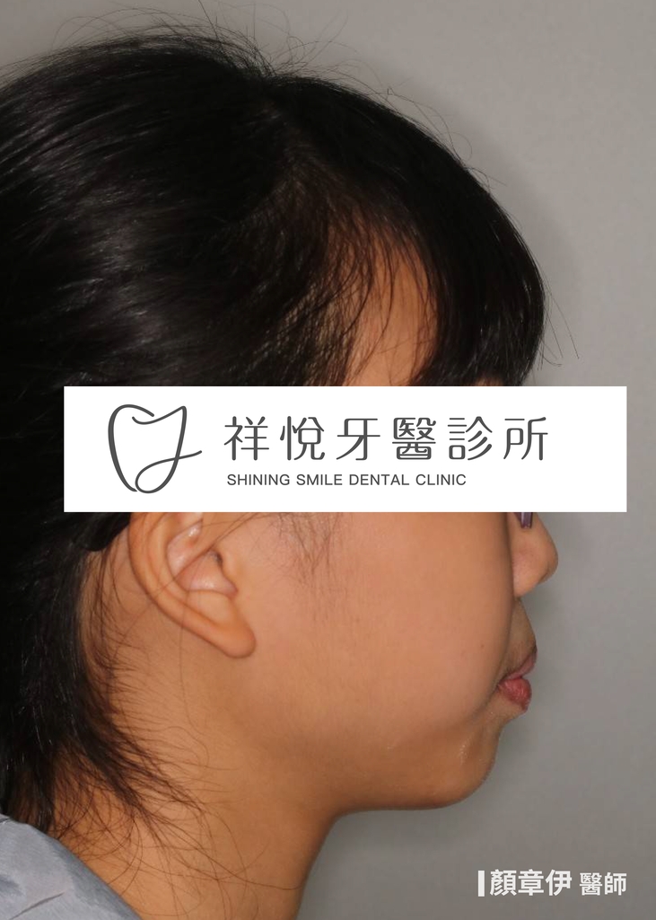 傳統矯正治療前