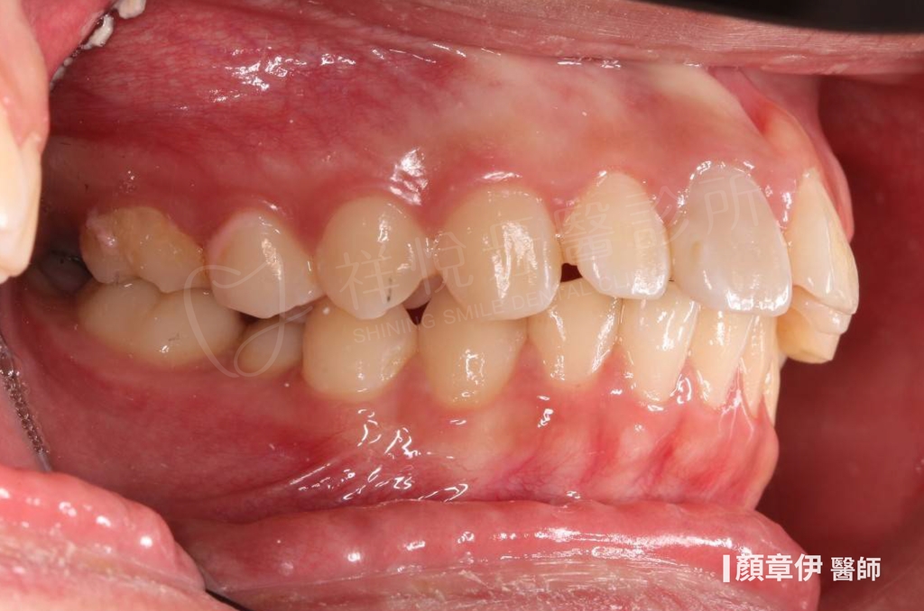 傳統矯正治療前