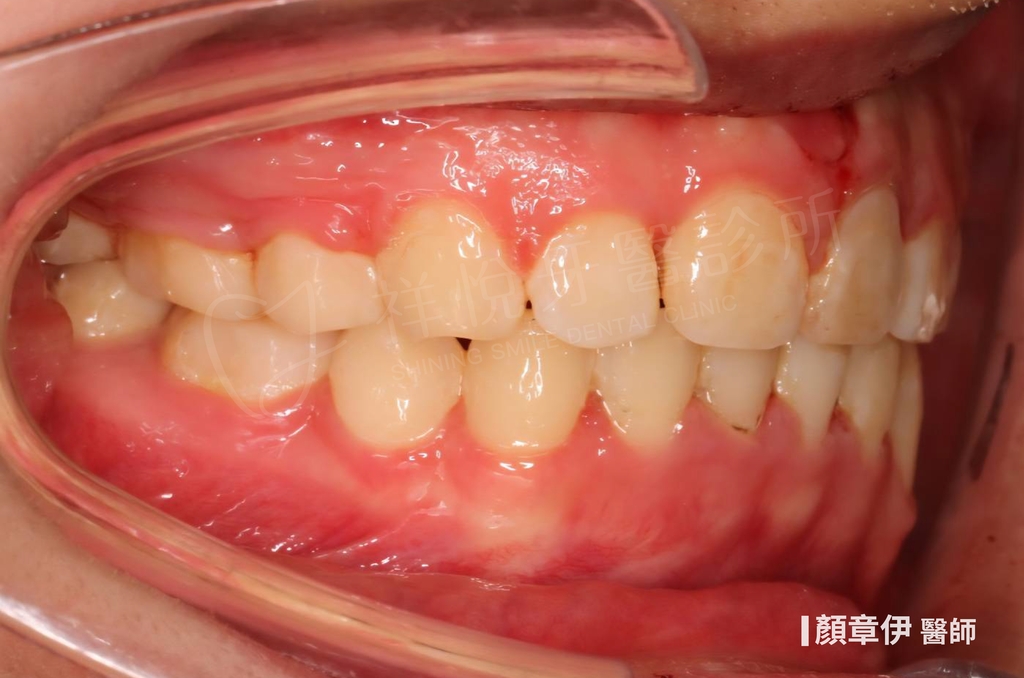 傳統矯正治療後