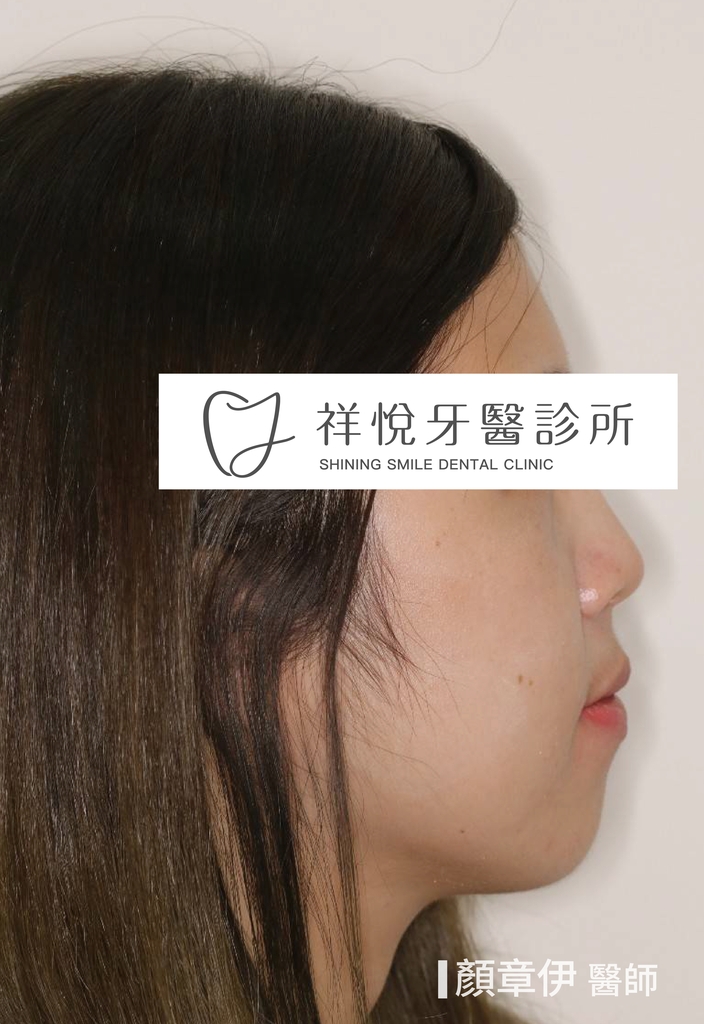 傳統矯正治療前