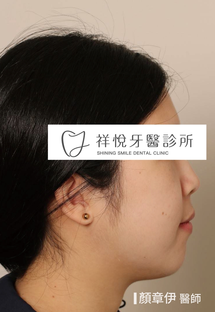 傳統矯正治療後