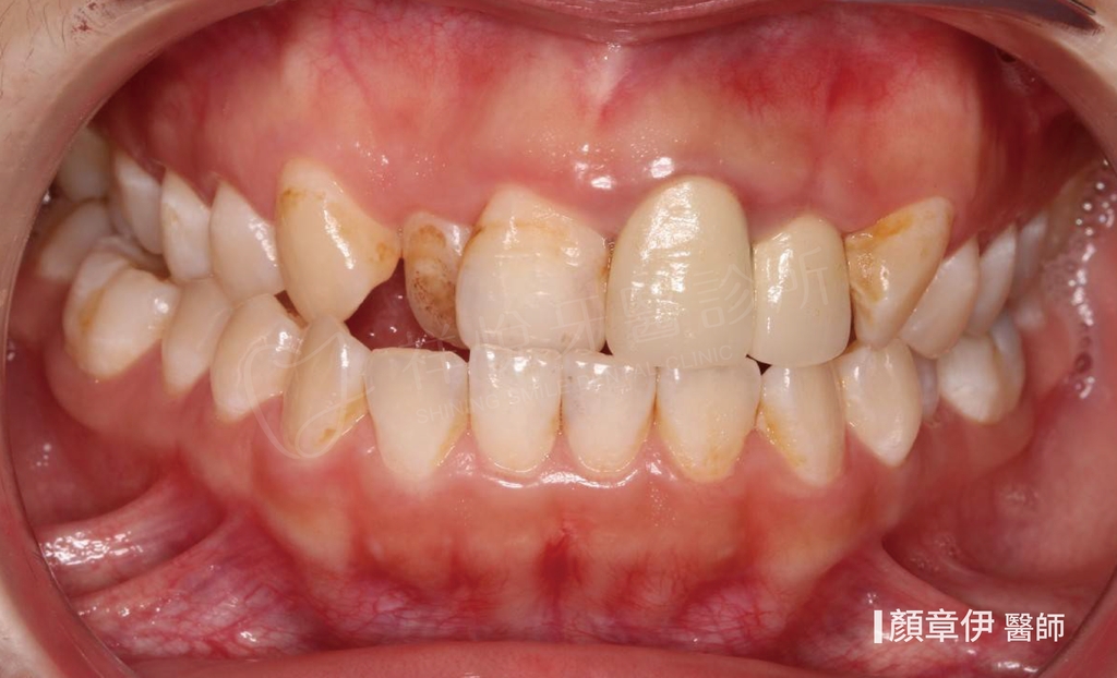 傳統矯正治療前