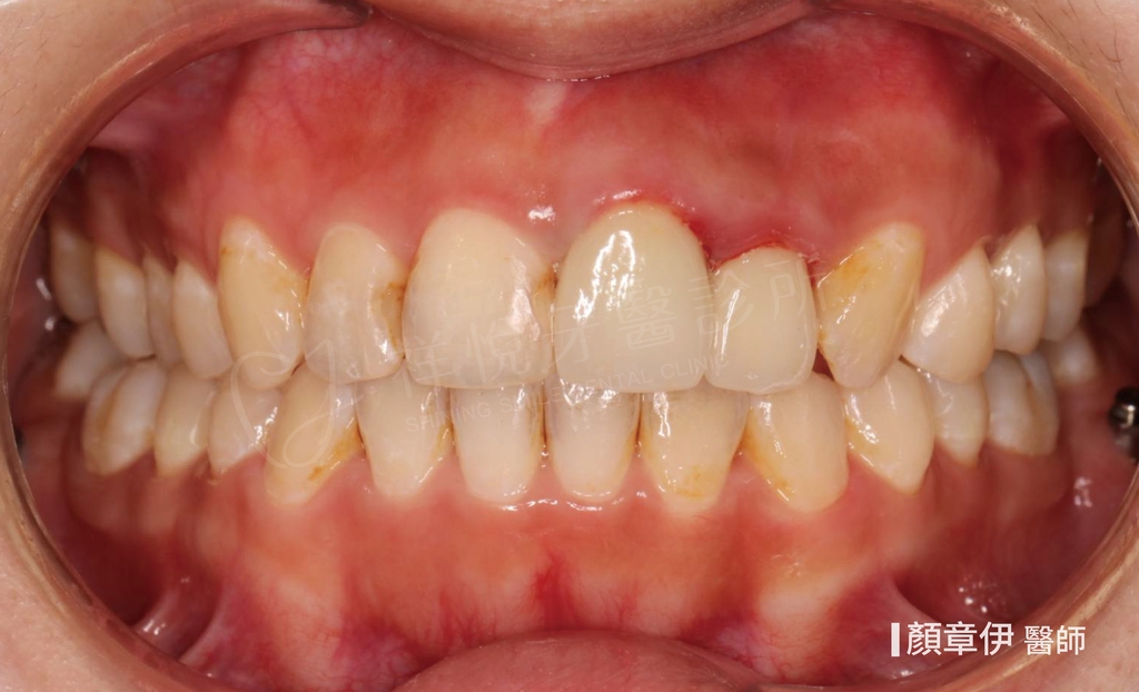 傳統矯正治療後