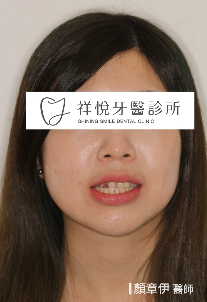 傳統矯正治療前