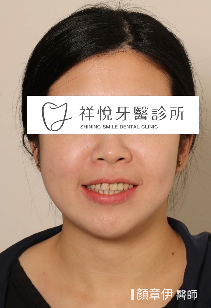 傳統矯正治療後