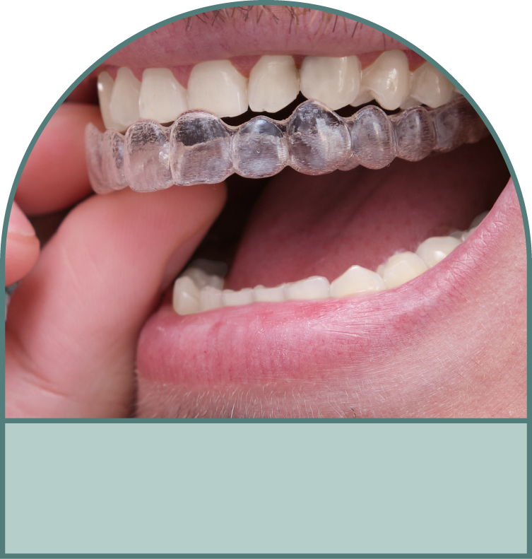 牙套隱形美觀自然