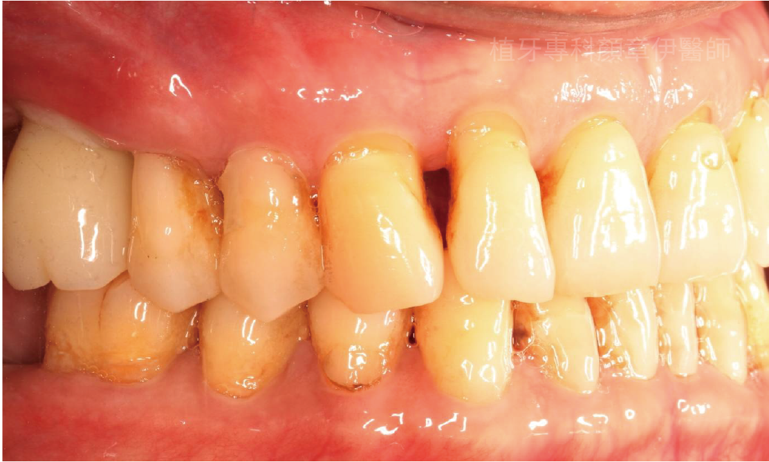 植牙後