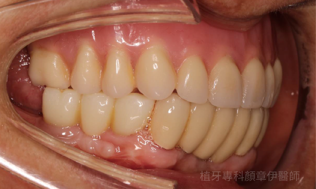 植牙後