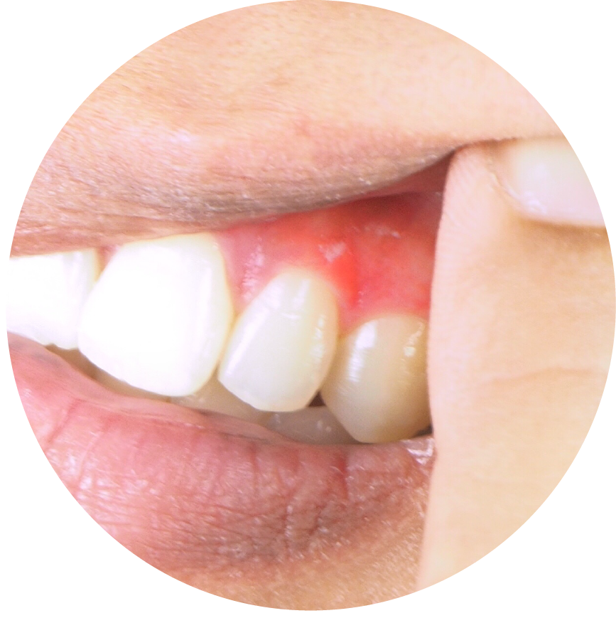 牙周病嚴重等級