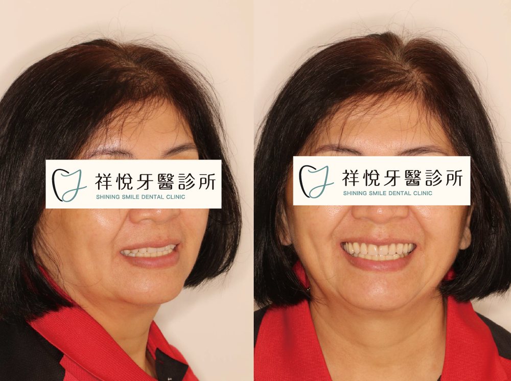 BPS吸附式活動假牙治療後臉部外觀｜湖口祥悅牙醫