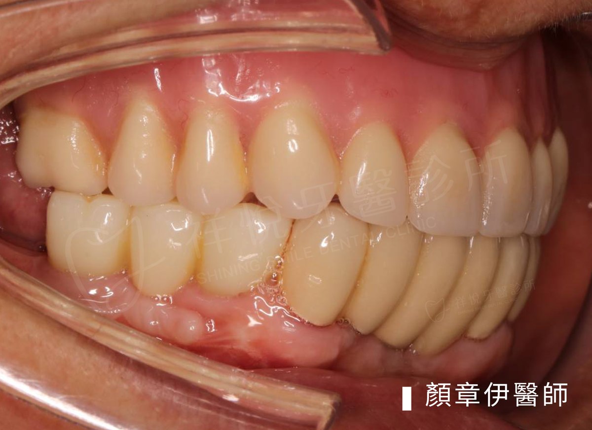 BPS吸附式活動假牙治療後口內照｜顏章伊醫師案例