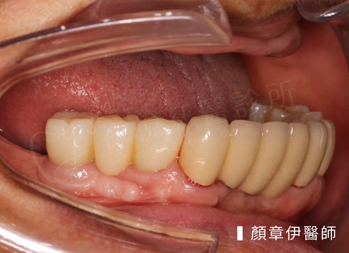 BPS吸附式活動假牙治療前口內照｜顏章伊醫師案例