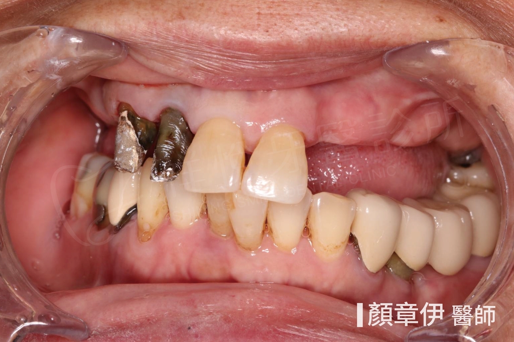 顏章伊醫師 後牙多顆缺牙植牙案例 治療前(湖口祥悅牙醫)