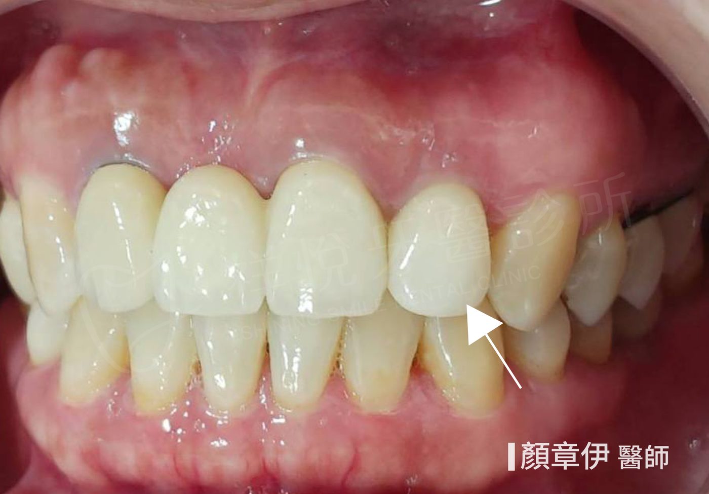 門牙即拔即種植牙治療後 與鄰牙相仿假牙 顏章伊醫師 祥悅牙醫