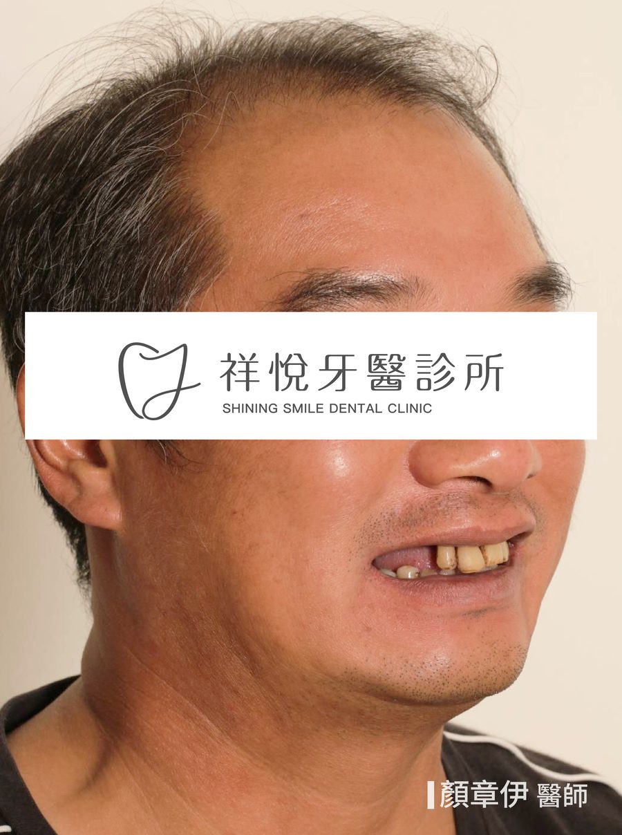 牙周病牙齒狀況不佳治療前 側面 上顎一日長城案例 顏章伊醫師 祥悅牙醫