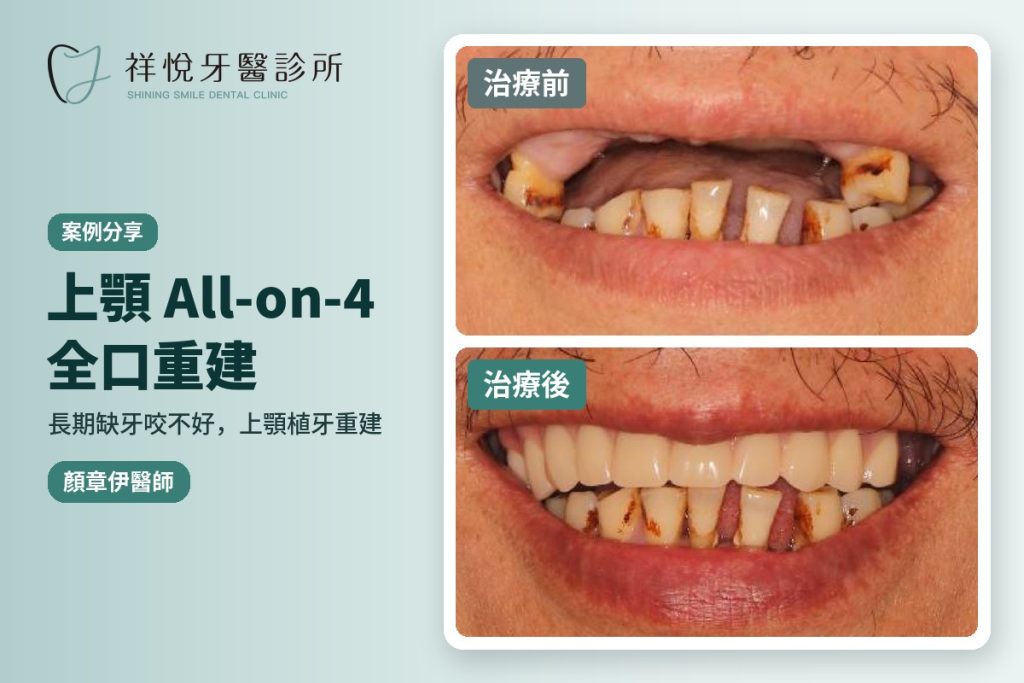 上顎All-on-4全口重建案例 治療前後對比 植牙專科顏章伊醫師|湖口祥悅牙醫