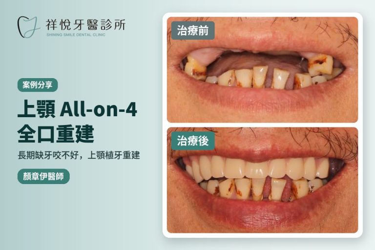 長期缺牙・上顎 All-on-4 全口重建案例